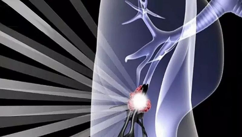 【光电科普知识】能治疗癌症的除了放疗、化疗……还有光！