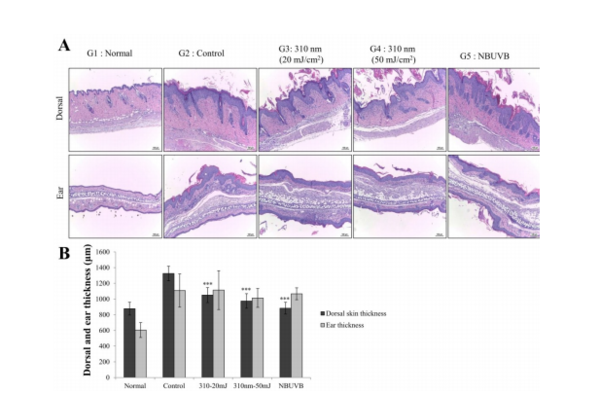 紫外线LED光疗法被证明有助于牛皮癣治疗效果